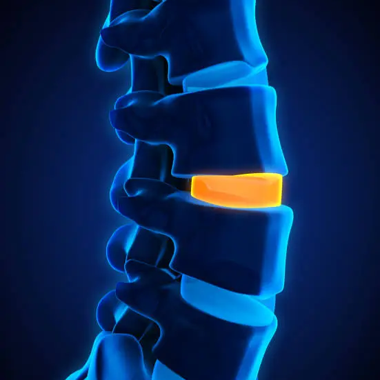 3D illustration of a spinal disc implant highlighted in orange — medtech competitive intelligence and market entry case study